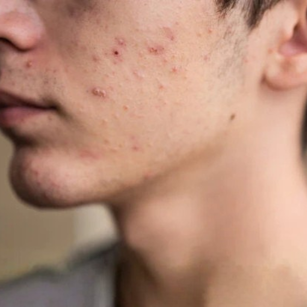 Puistjes rond je kaaklijn: oorzaak & behandeling - Active Skin