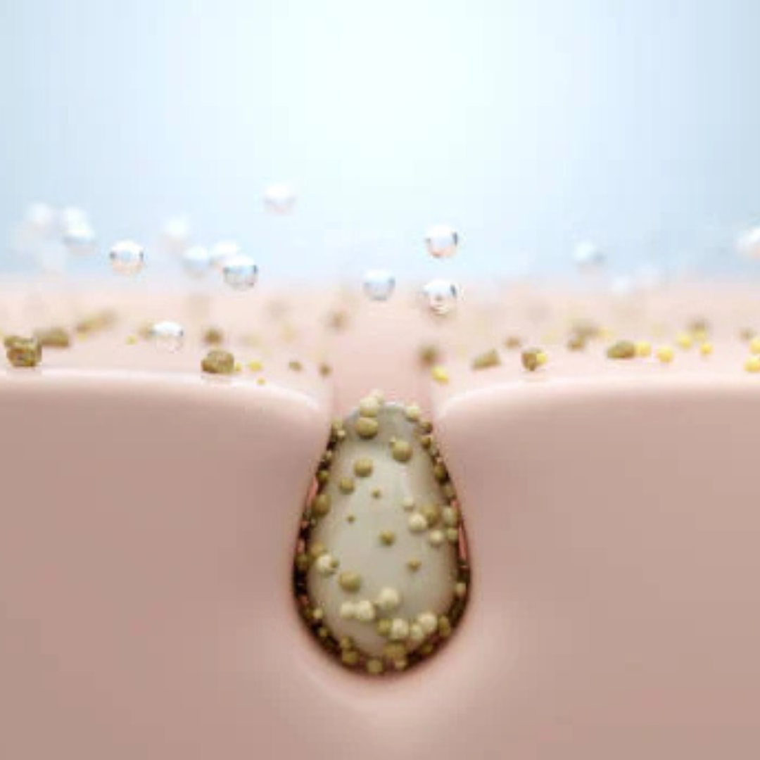 Ontstoken talgklier aanpakken: tips & behandeling - Active Skin