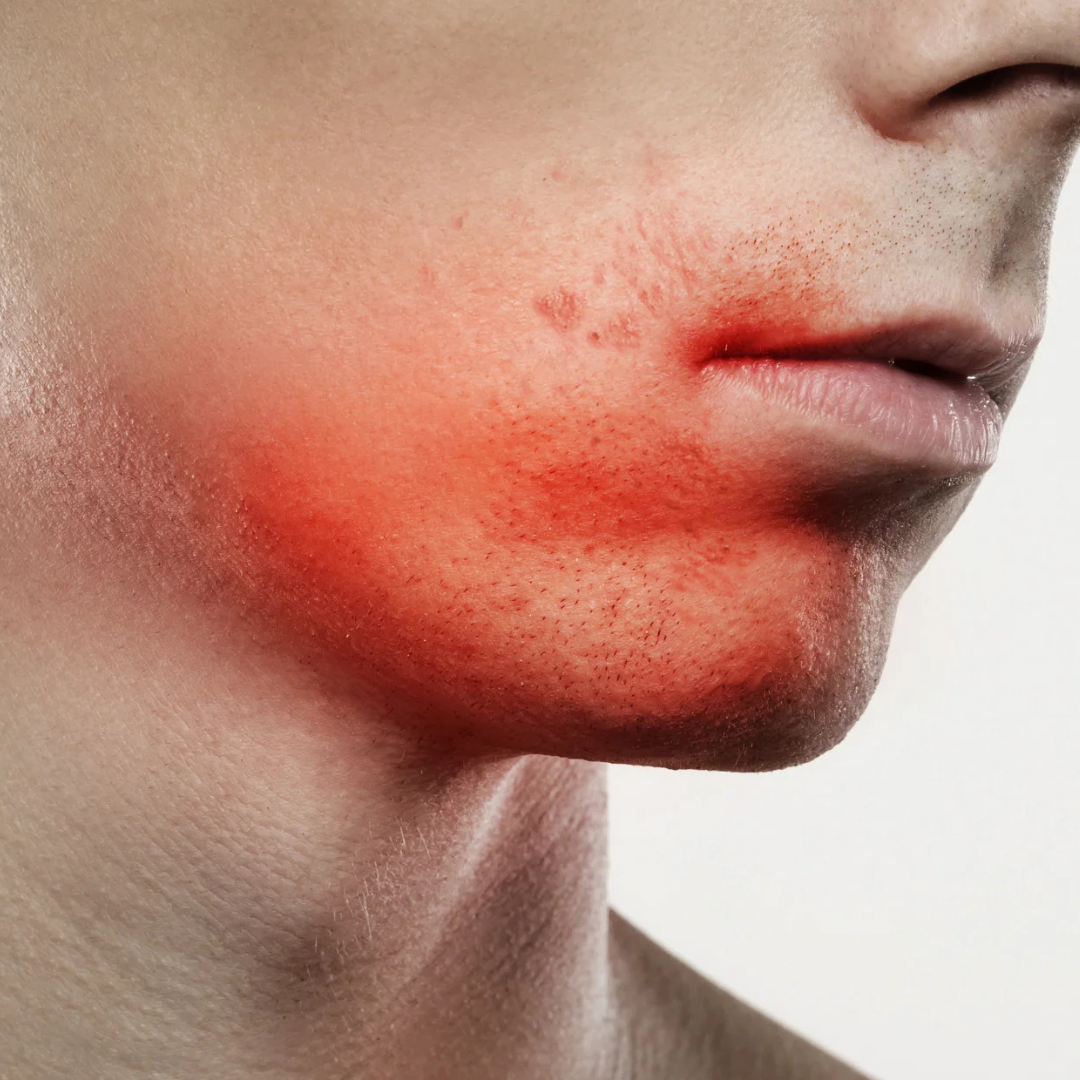 Puistjes na het scheren bij mannen: de oorzaak en oplossing - Active Skin