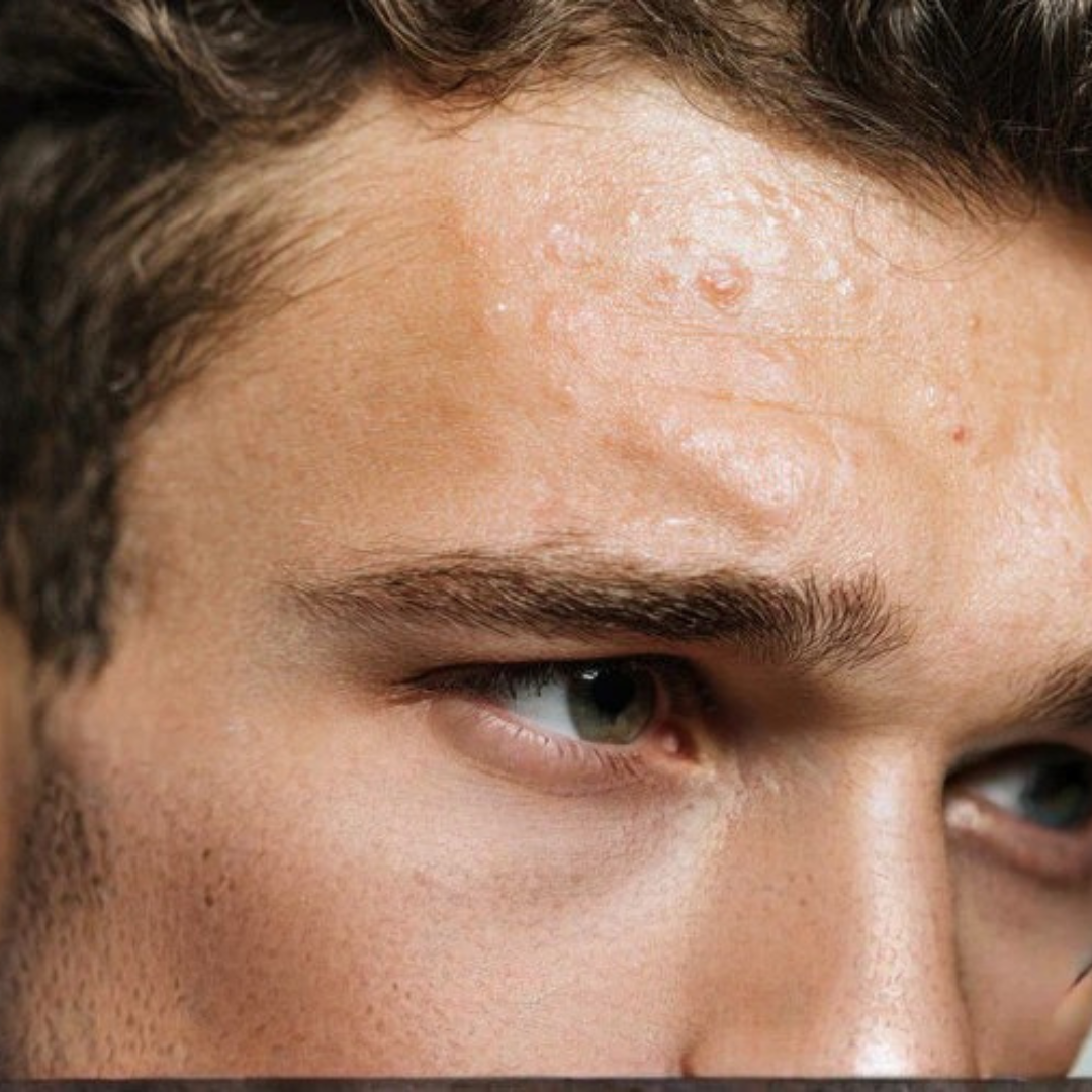 Vette huid & puistjes: wat werkt echt? - Active Skin