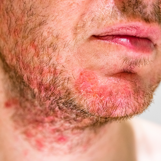 Wat is een geïrriteerde huid? Wat doe je ertegen? - Activeskin