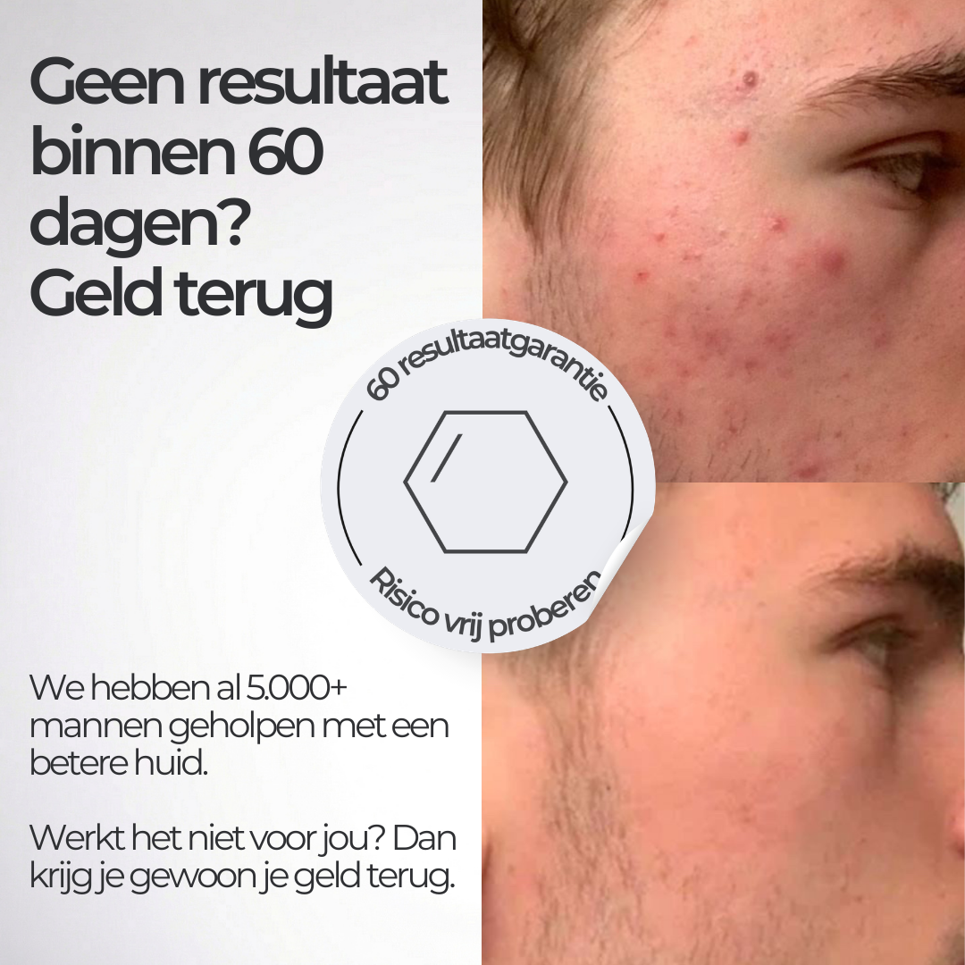 Face Bundle - Complete Acne Verzorgingsroutine met Face Wash, Dag- & Nachtcrème