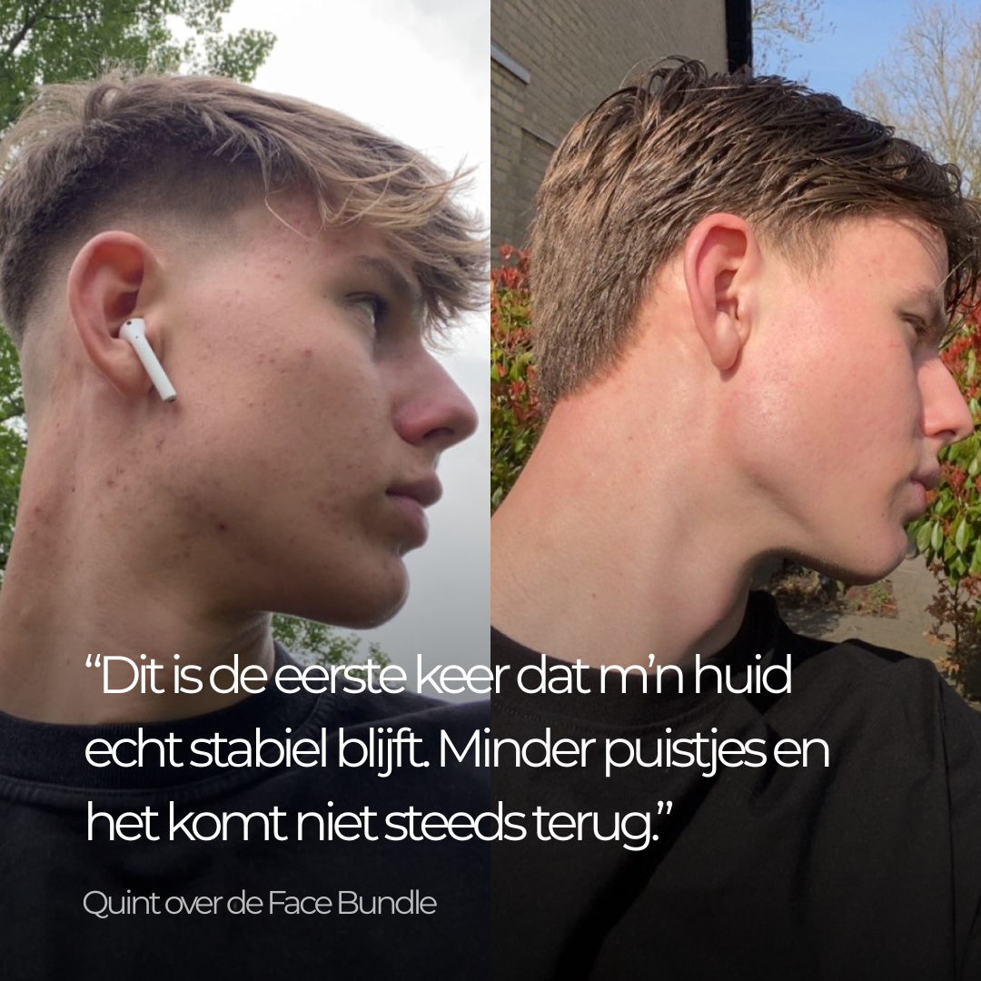 Face Bundle - Complete Acne Verzorgingsroutine met Face Wash, Dag- & Nachtcrème