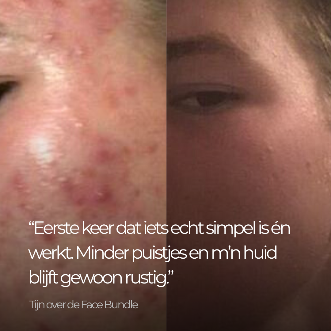 Face Bundle - Complete Acne Verzorgingsroutine met Face Wash, Dag- & Nachtcrème
