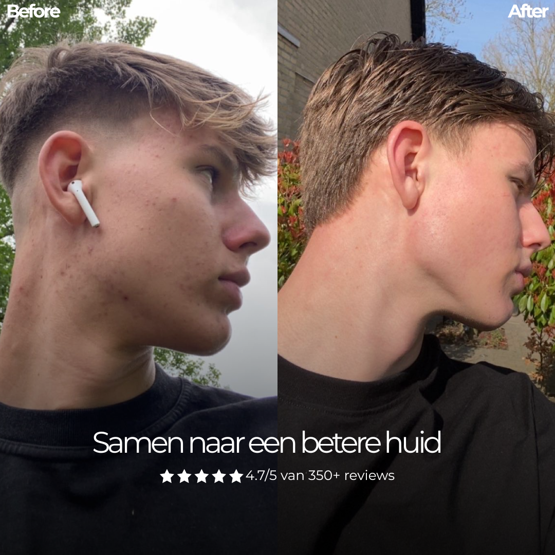 Basic Bundle – Basis Acne Routine met Face Wash & Dagcrème tegen Onzuiverheden & Puistjes