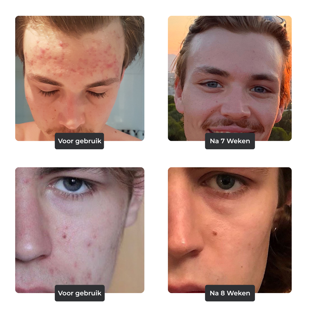 Face Bundle - Complete Acne Verzorgingsroutine met Face Wash, Dag- & Nachtcrème