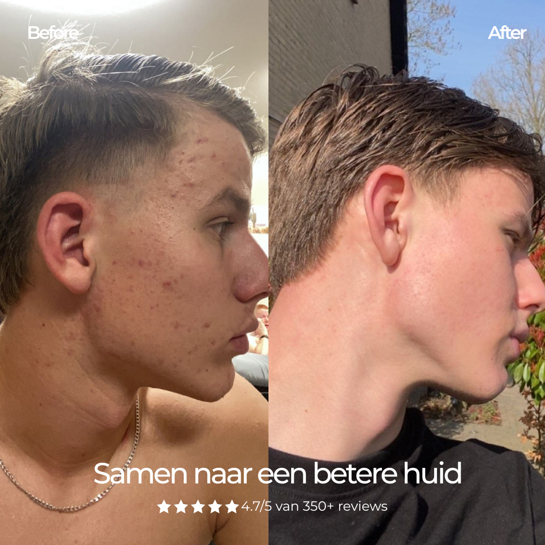 Face Wash - Gezichtsreiniger Mannen met Glycerine tegen Acne & Puistjes