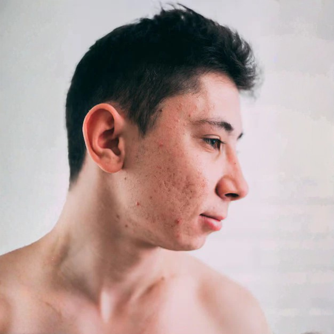 Acne littekens waarom ze ontstaan en hoe je ze effectief kunt verminderen - Active Skin