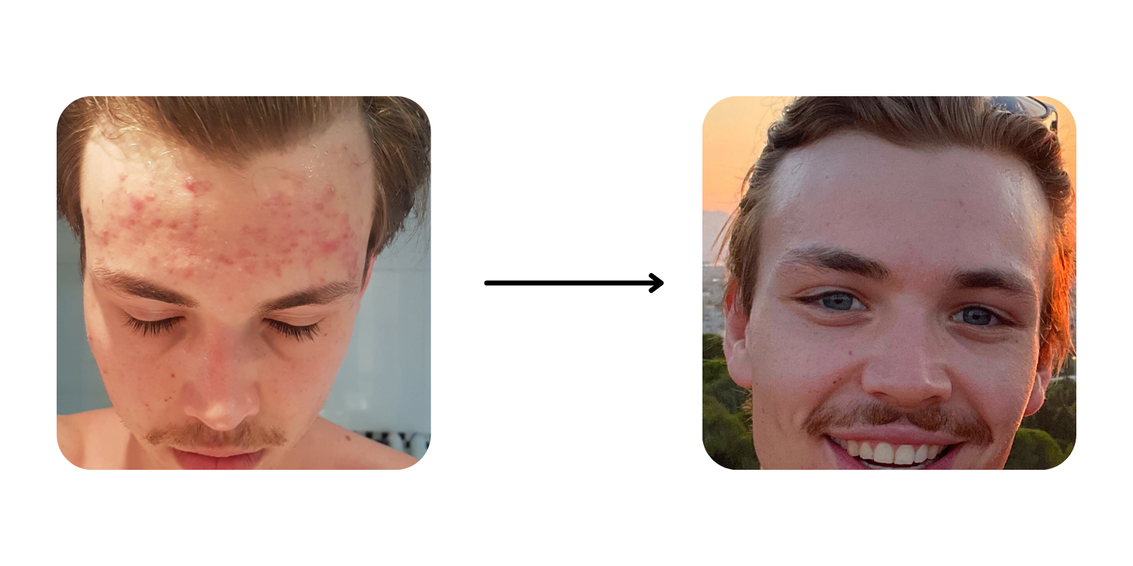 De ultieme acne-skincare routine voor mannen: van reiniger tot nachtcrème