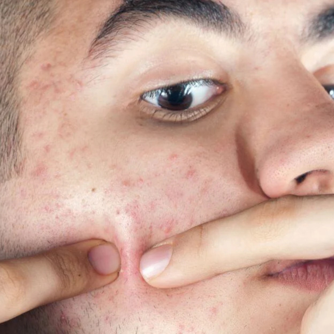 Puistjes weg in 24 uur: wat werkt echt en wat niet - Activeskin