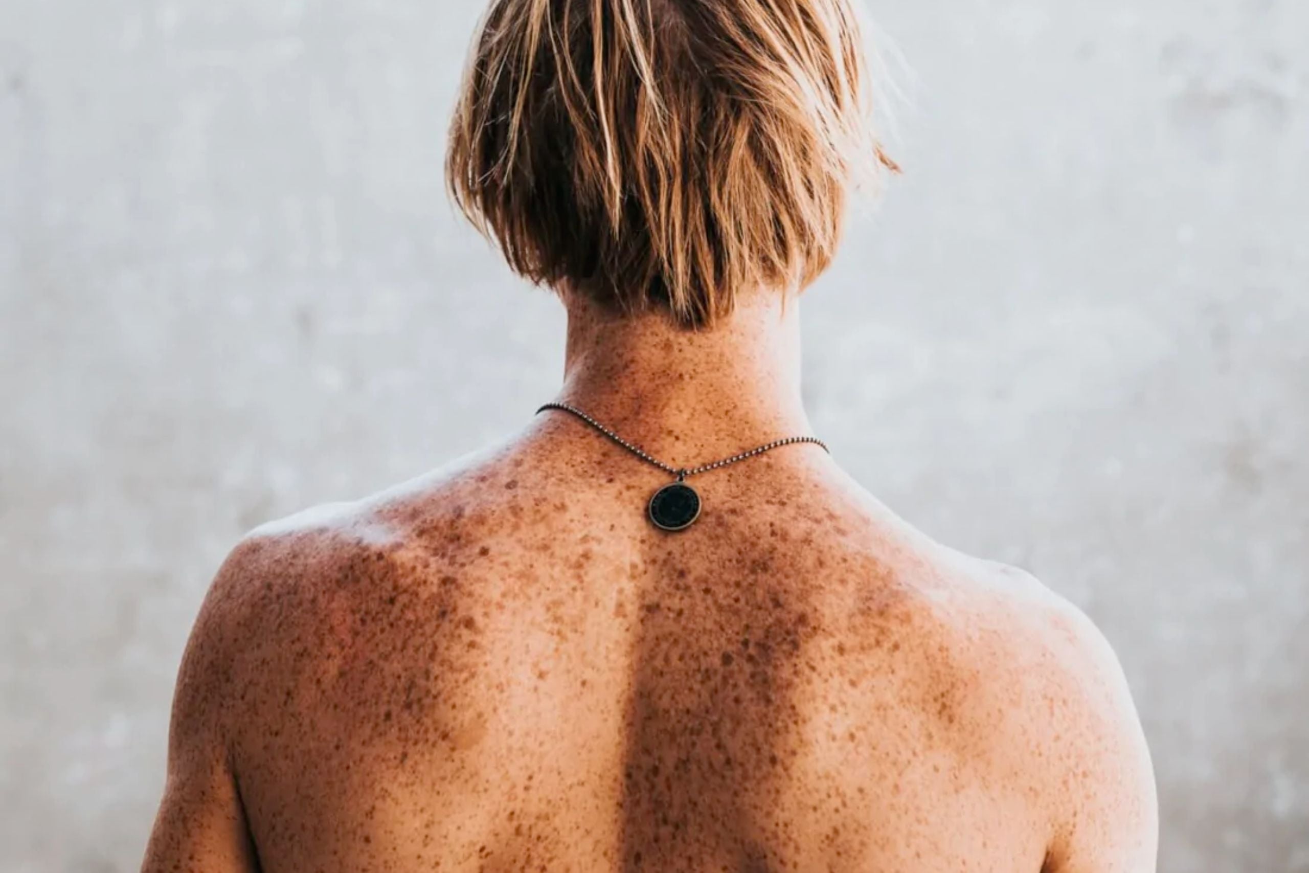 Puistjes op rug en schouders - Activeskin