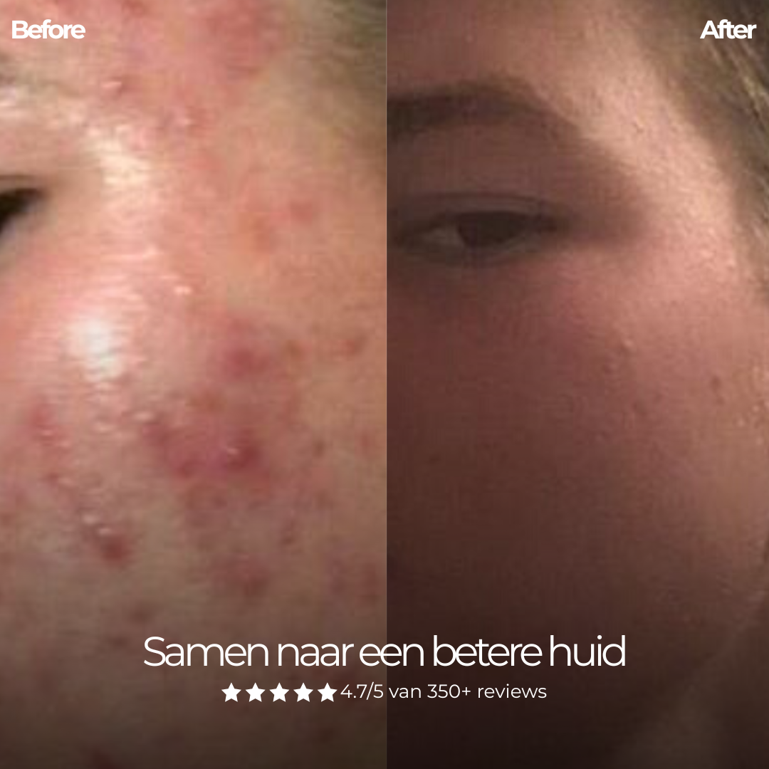 Face Control - Dagcrème Mannen met Retinol en Zink tegen Acne & Onzuiverheden