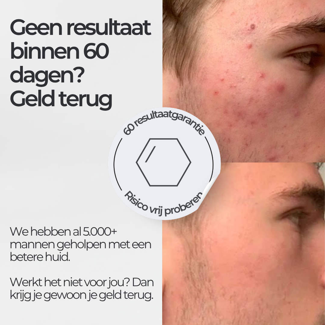 Face Bundle - Complete Acne Verzorgingsroutine met Face Wash, Dag- & Nachtcrème