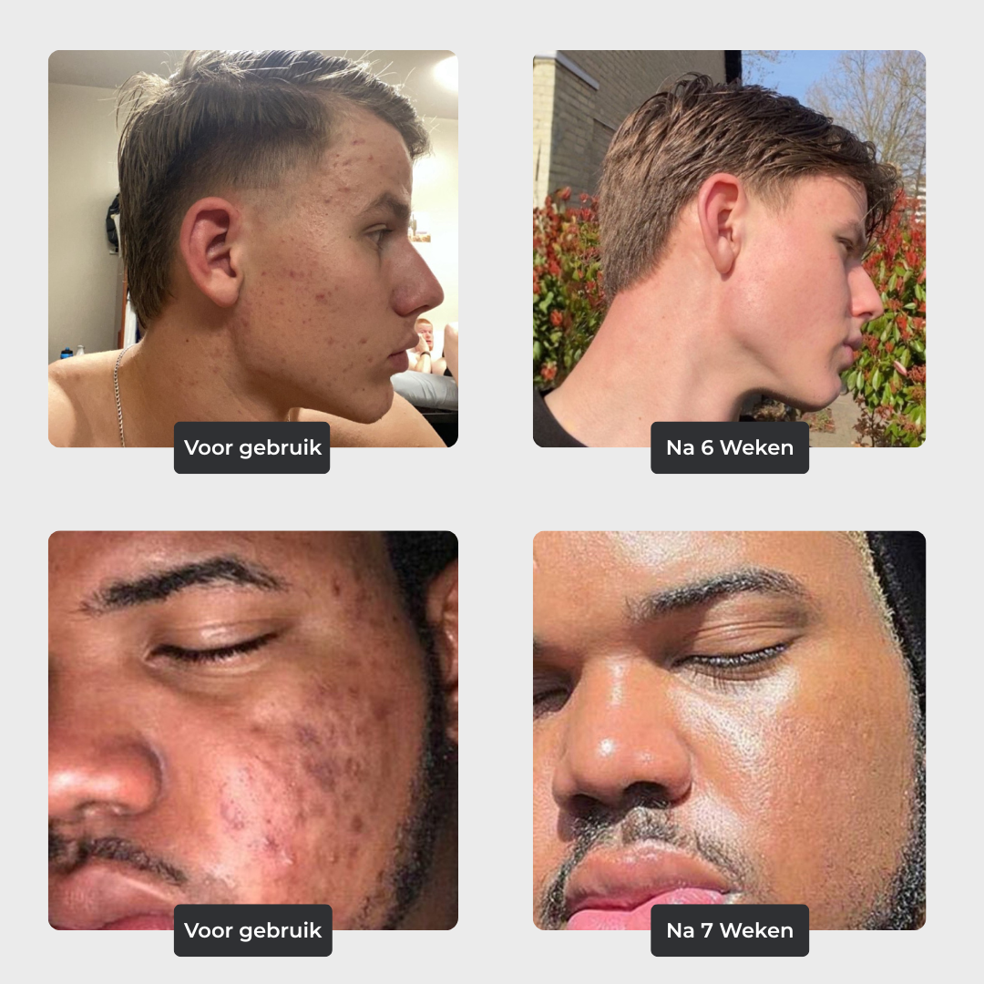 Face Control - Dagcrème Mannen met Retinol en Zink tegen Acne & Onzuiverheden