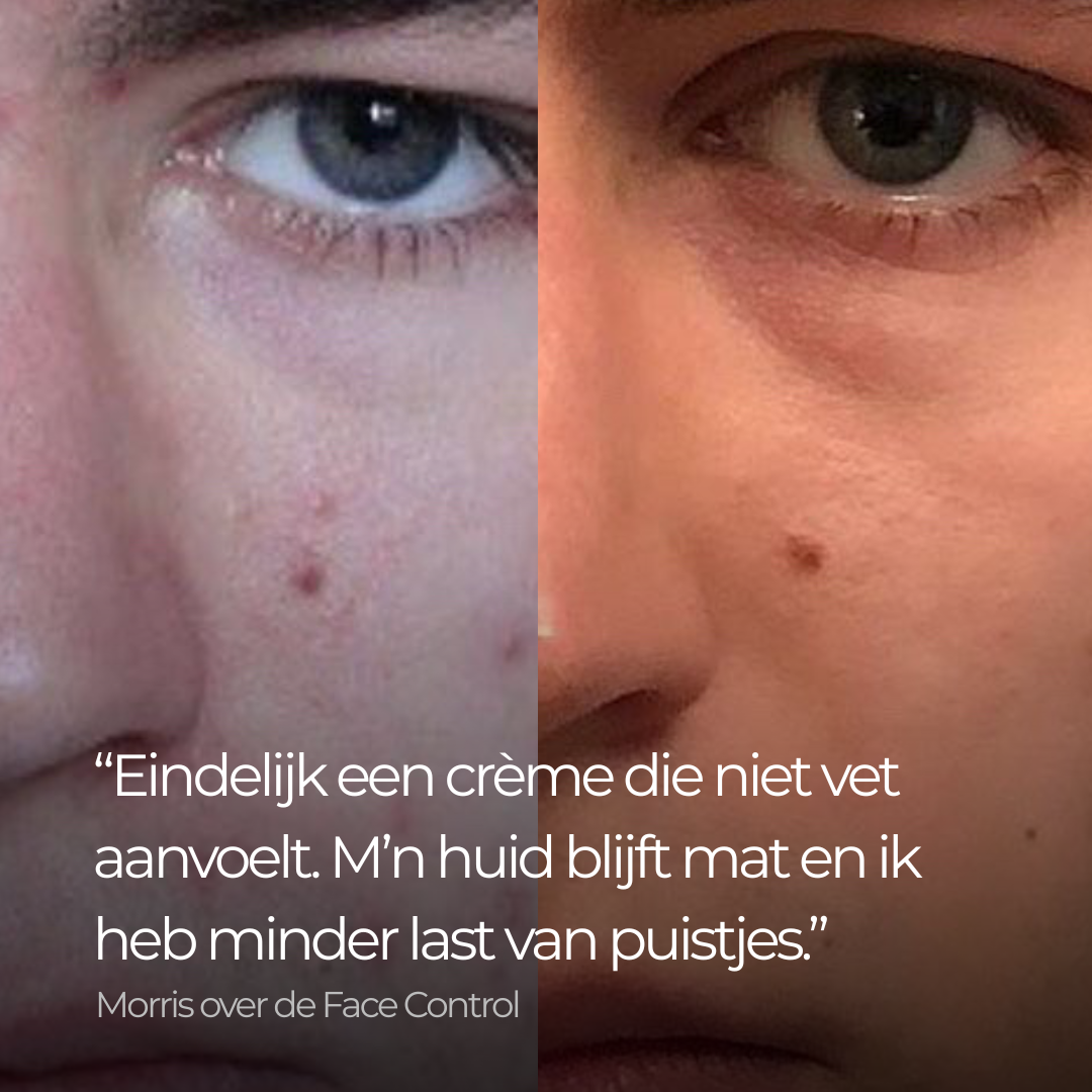 Face Control - Dagcrème Mannen met Retinol en Zink tegen Acne & Onzuiverheden