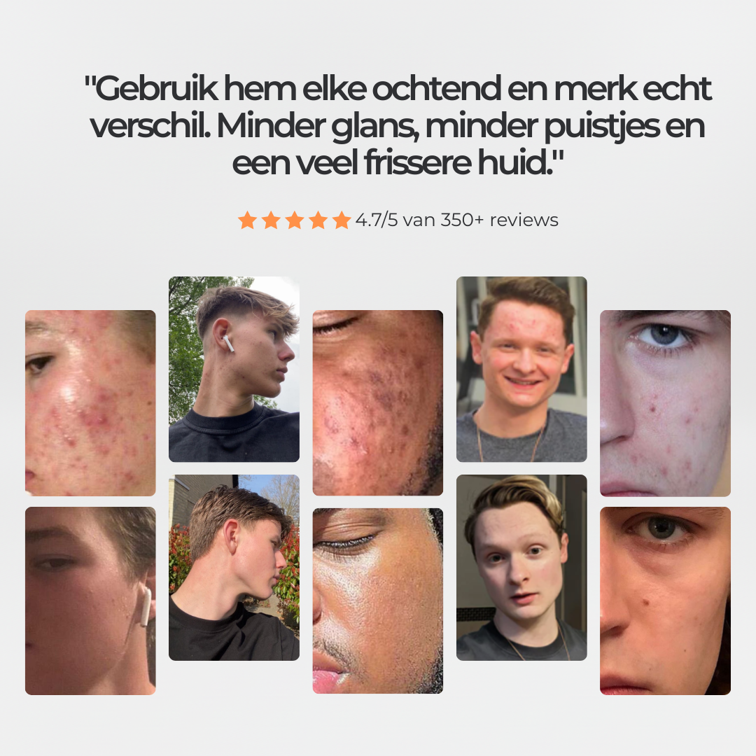 Face Control - Dagcrème Mannen met Retinol en Zink tegen Acne & Onzuiverheden