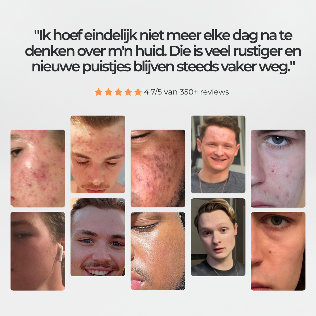 Face Bundle - Complete Acne Verzorgingsroutine met Face Wash, Dag- & Nachtcrème