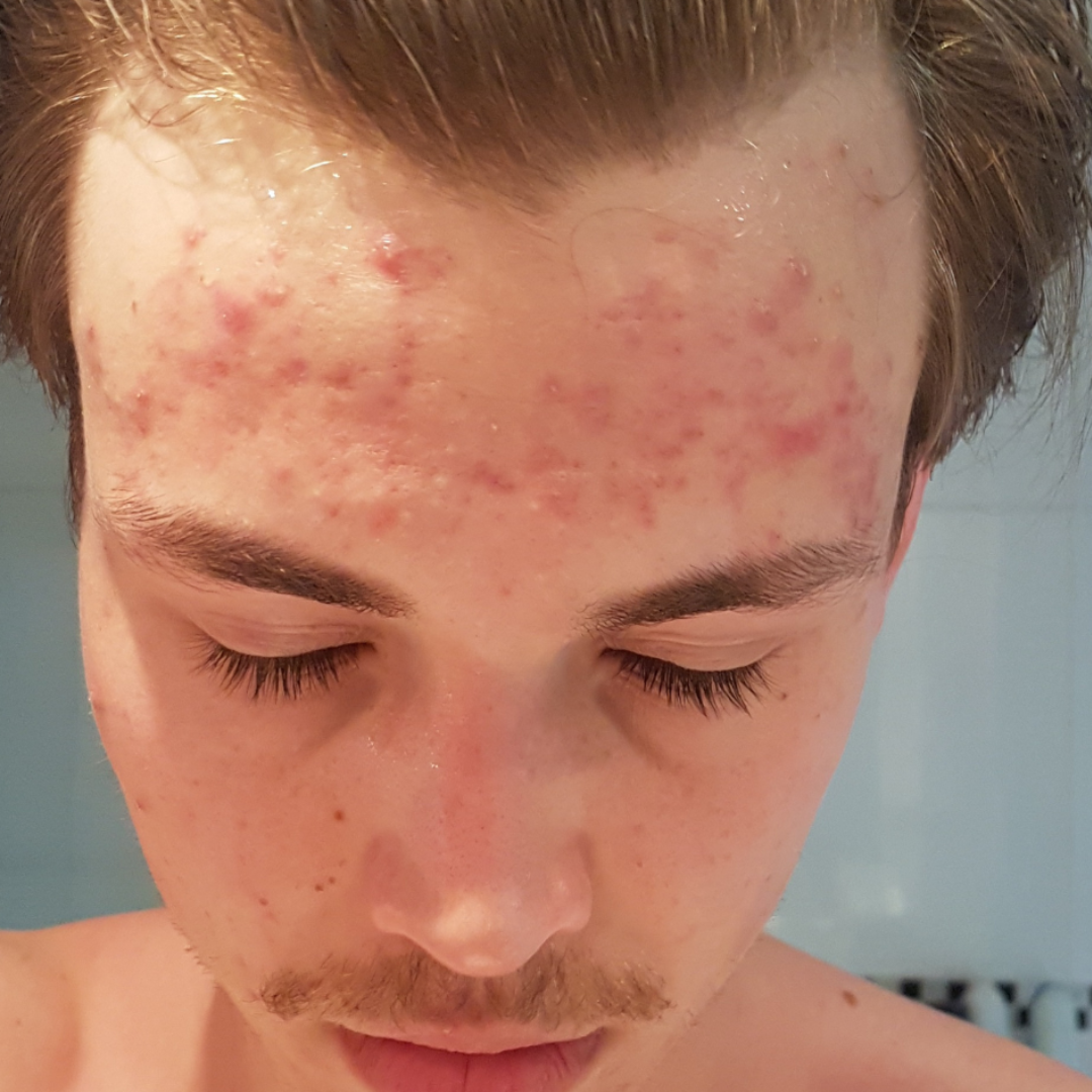 active skin | acnebehandeling voor mannen